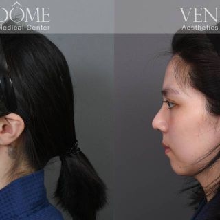 療程效果因人而異，上圖為該案例實際進行 FITme 完形美 客製化3D列印矽膠假體+取肋骨延長鼻中膈+雕鼻頭 之術後效果